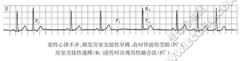 窦性心律不齐、频发房室交接性早搏，有时伴前传受阻、房室交接性逸搏逆传时出现房性融合波（心电图）