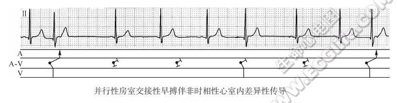 房室交接性并行心律的心电图表现