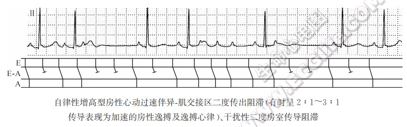 2度2型传出阻滞