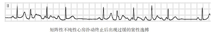 短阵性不纯性心房扑动终止后出现过缓的窦性逸搏（心电图）