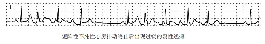 窦性逸搏和逸搏心律