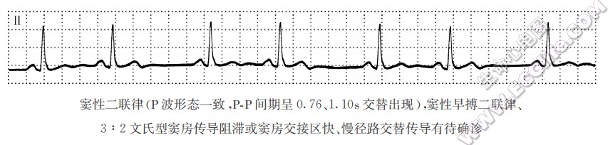 窦性早搏（心电图）