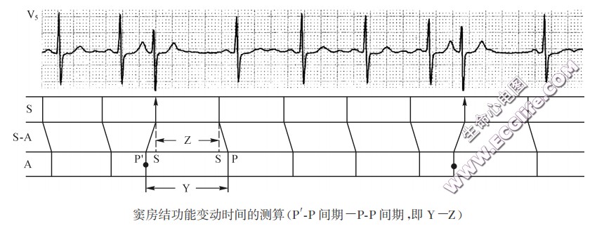 窦房结功能变动时间的测算（心电图）