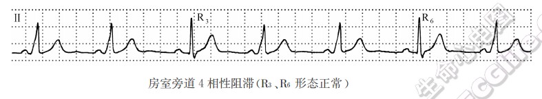 房室旁道4相性阻滞