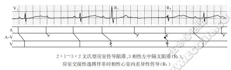 2：1-3：2文氏型房室传导阻滞、3相性左中隔支阻滞(R3)、房室交接性逸搏伴非时相性心室内差异性传导(R4)