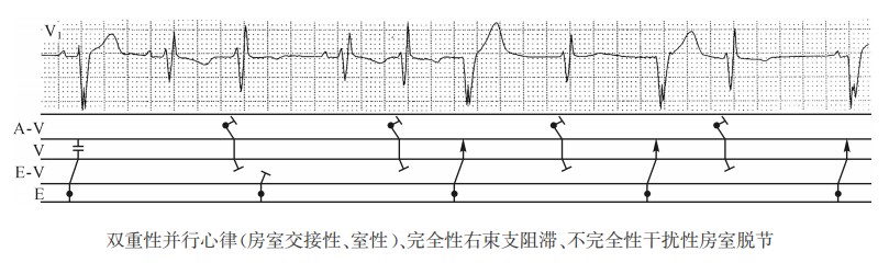 多重性并行心律、与束支阻滞有关的室性并行心律