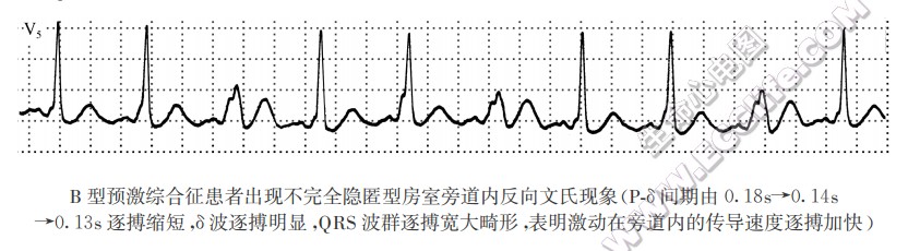 B型预激综合征患者m现不完全隐匿型房室旁道内反向文氏现象（心电图）