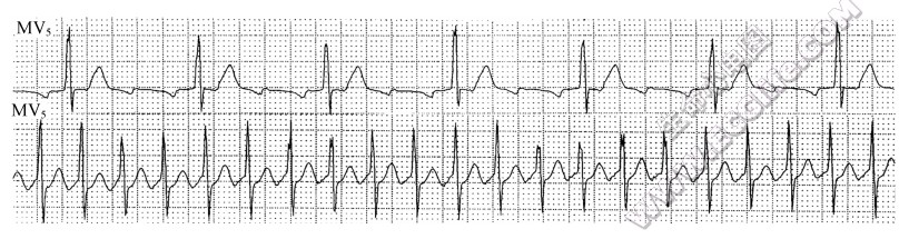 房室呈1:1传导（心电图）
