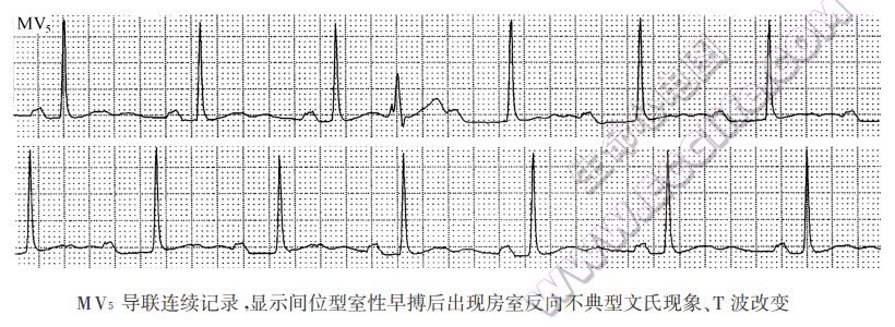 MV5导联连续记录湿示间位型室性早搏后出现房室反向不典型文氏现象、T波改变（心电图）