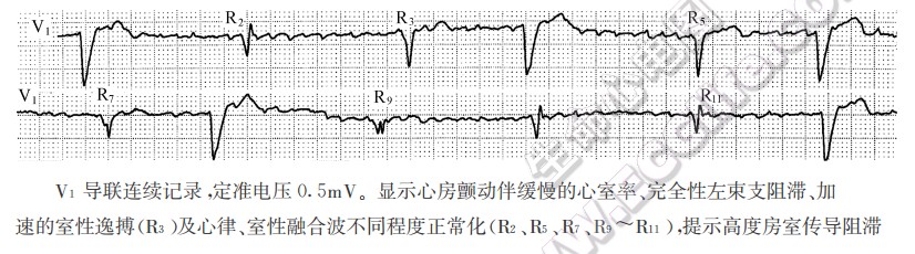 合并高度房室传导阻滞（心电图）