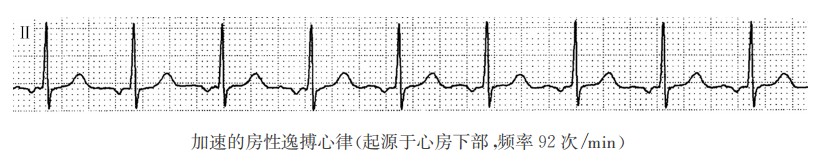 加速的房性逸搏心律（心电图）