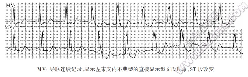 MV5导联连续记录，显示左束支内不典型的直接显示型文氏现象、ST段改变（心电图）