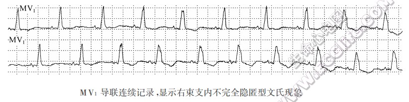 MV1导联连续记录湿示右束支内不完全隐匿型文氏现象（心电图）