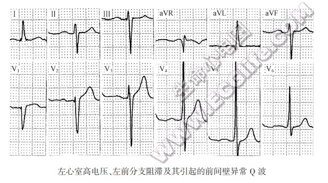 左心室高电压、左前分支阻滞及其引起的前间壁异常O波（心电图）