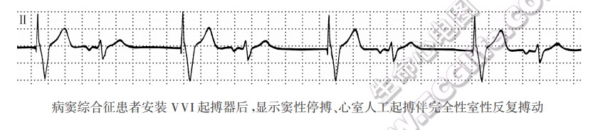 病窦综合征患者安装VVI起搏器后，显示窦性停搏、心室人工起搏伴完全性室性反复搏动（心电图）