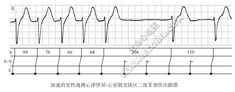 加速的室性逸搏心律伴异一心室肌交接区二度Ⅱ型传出阻滞（心电图）