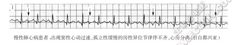 慢性肺心病患者，出现窦性心动过速、孤立性缓慢的房性异位节律伴不齐、心房分离（引自都兴亚）（心电图）