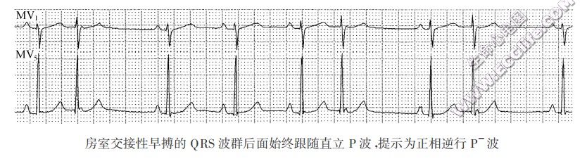 房室交接性早搏的QRS波群后面始终跟随直立P波，提示为正相逆行P-波