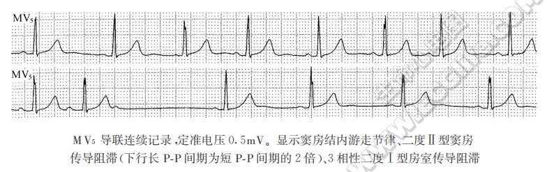 3相性二度房窒传导阻滞