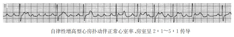自律性增高型心房扑动伴正常心室率，房室呈2：1～5：1传导（心电图）