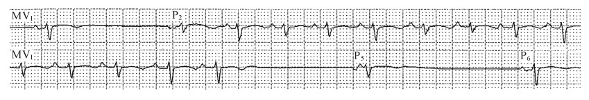 房性逸搏和逸搏心律心电图特点