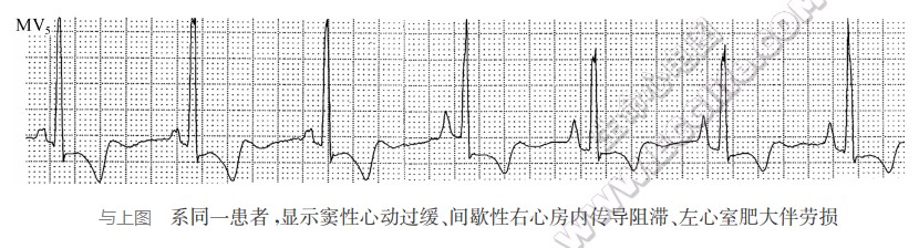 窦性心动过缓、间歇性右心房内传导阻滞、左心窒肥大伴劳损（心电图）