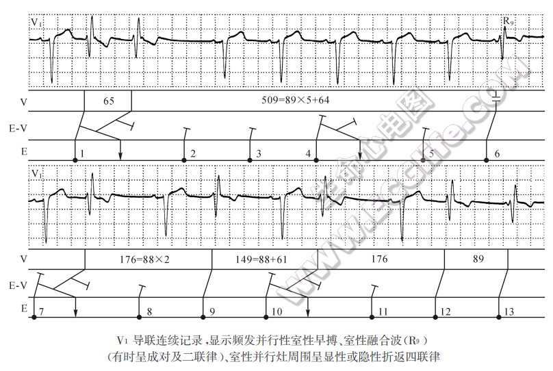 室性并行灶周围呈显性或隐性折返四联律（心电图）