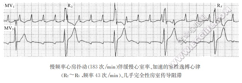 几乎完全性房室传导阻滞（心电图）