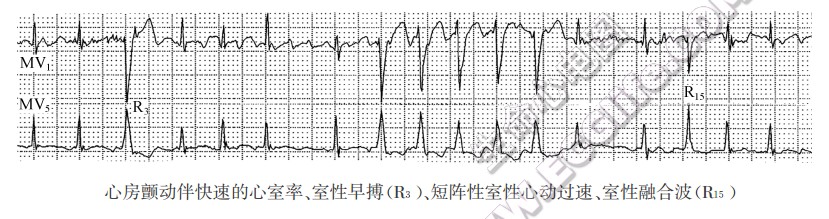 心房颤动伴快速的心室率、室性早搏(R3)、短阵性室性心动过速、室性融合波(Ris)（心电图）