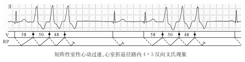 短阵性窒性心动过速、心室折返径路内4:3反向文氏现象（心电图）