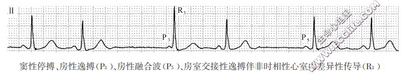 窦性停搏、房性逸搏(P3)、房性融合波(P5)、房室交接性逸搏伴非时相性心室内差异性传导(R3)（心电图）