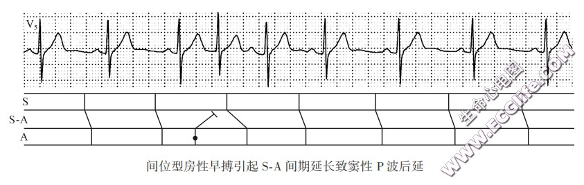 间位型房性早搏引起S-A间期延长致窦性P波后延