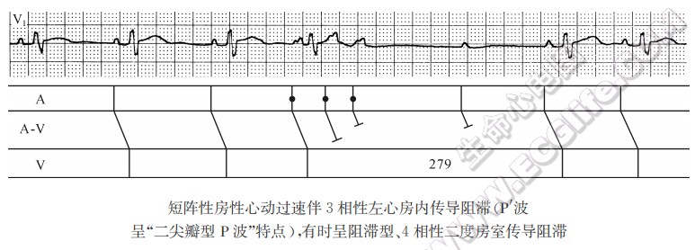 短阵性房性心动过速伴3相性左心房内传导阻滞（P'波呈“二尖瓣型P波”特点），有时呈阻滞型、4相性二度房室传导阻滞