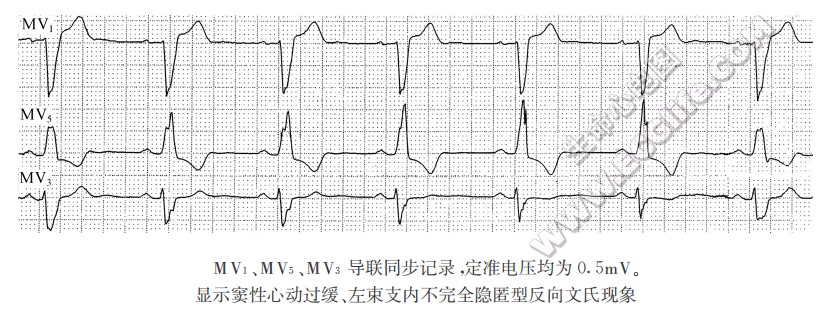 MV1、MV5、MV3导联同步记录，定准电压均为0.5mV。显示窦性心动过缓、左柬支内不完全隐匿型反向文氏现象（心电图）