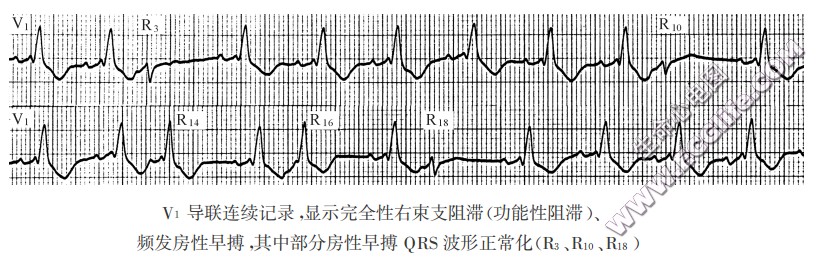 V1导联连续记录，显示完全性右柬支阻滞（功能性阻滞）、频发房性早搏，其中部分房性早搏QRS波形正常化（R3、R10、R18）（心电图）