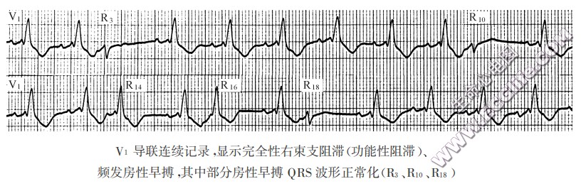 早搏波形正常化