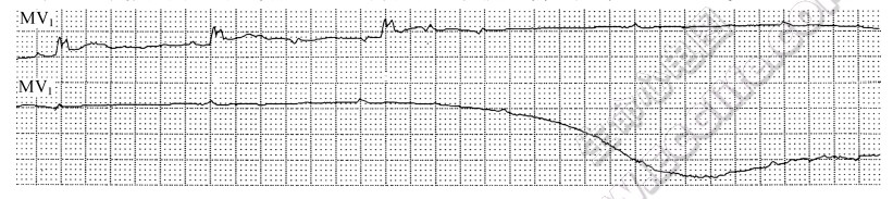 3相性二度房室传导阻滞诱发4相性阵发性三度房室传导阻滞