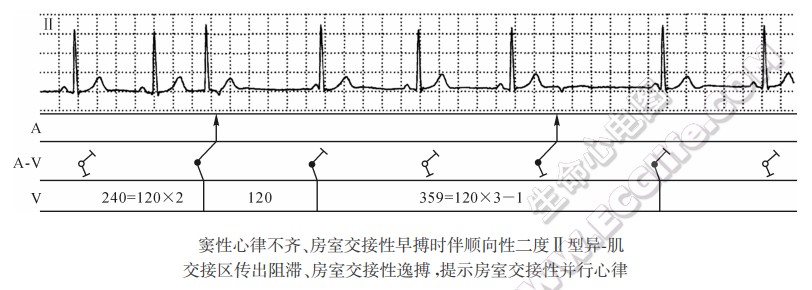 窦性心律不齐、房室交接性早搏时伴顺向性二度Ⅱ型异-肌交接区传出阻滞、房室交接性逸搏，提示房室交接性并行心律（心电图）