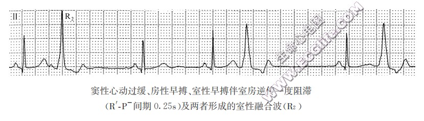 室性早搏伴一度室房传导阻滞（心电图）