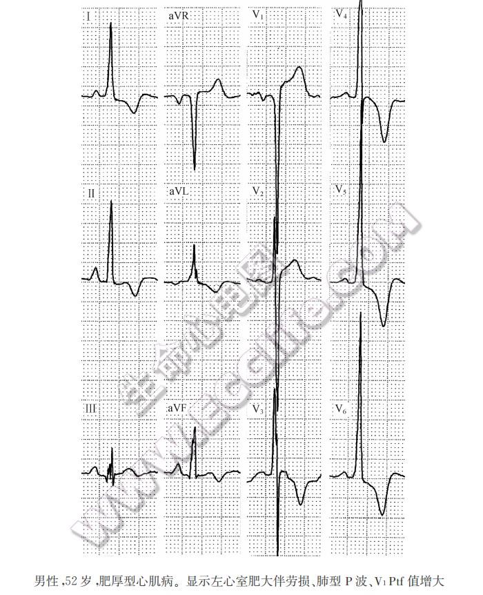 男性，52岁肥厚型心肌病。显示左心室肥大伴劳损、肺型P波、V1Ptf值增大（心电图）