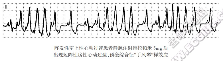 典型的预激综合征（WPW综合征）的心电图表现