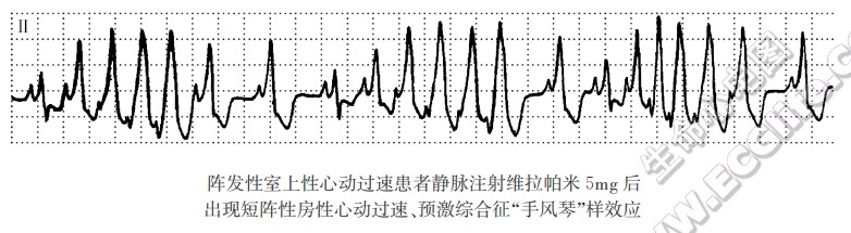 阵发性室上性心动过速患者静脉注射维拉帕米5mg后出现短阵性房性心动过速、预激综合征“手风琴”样效应（心电图）