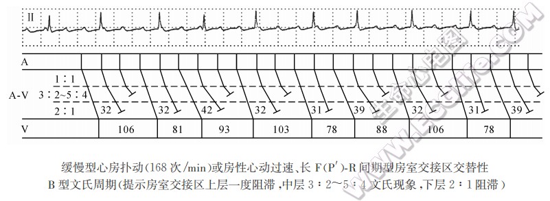 长PR间期型交替性文氏周期B型