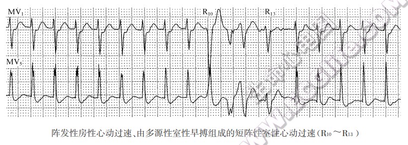 阵发性房性心动过速、由多源性室性早搏组成的短阵性室性心动过速(R40-R10)