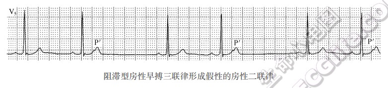 房性二联律的类型及心电图特征