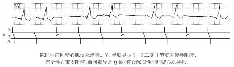 3:2二度Ⅱ型窦房传导阻滞