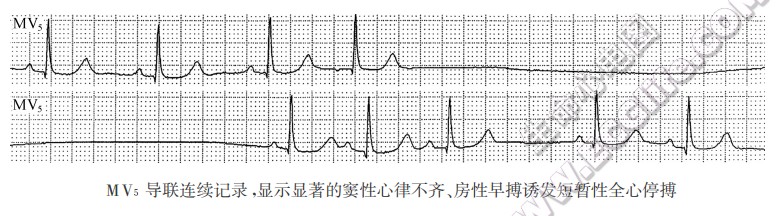 MV5导联连续记录，显示显著的窦性心律不齐、房性早搏污发短暂性全心停搏（心电图）