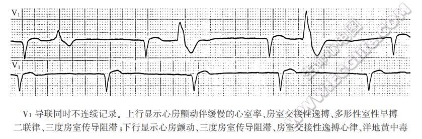 房室分离：完全性阻滞性、混合性房室分离