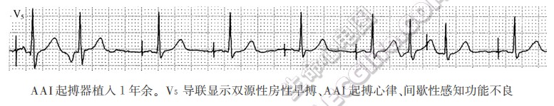 AAI起搏器植入1年余。V5导联显示双源性房性早搏、AAI起搏心律、间歇性感知功能不良