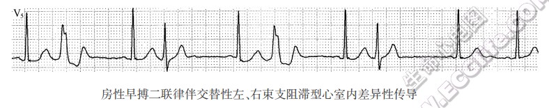房性早搏二联律伴交替性左、右柬支阻滞型心室内差异性传导（心电图）